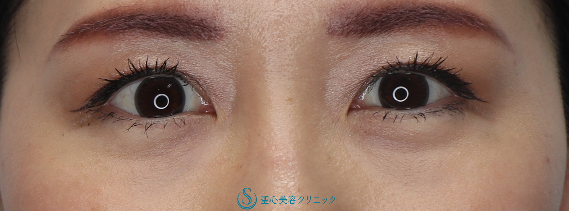 症例写真 術後 目の下の脂肪取り（経結膜下脱脂法）