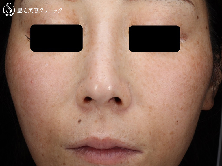 美容皮膚科 シミ そばかす 肝斑 の症例写真 聖心美容クリニック大阪院