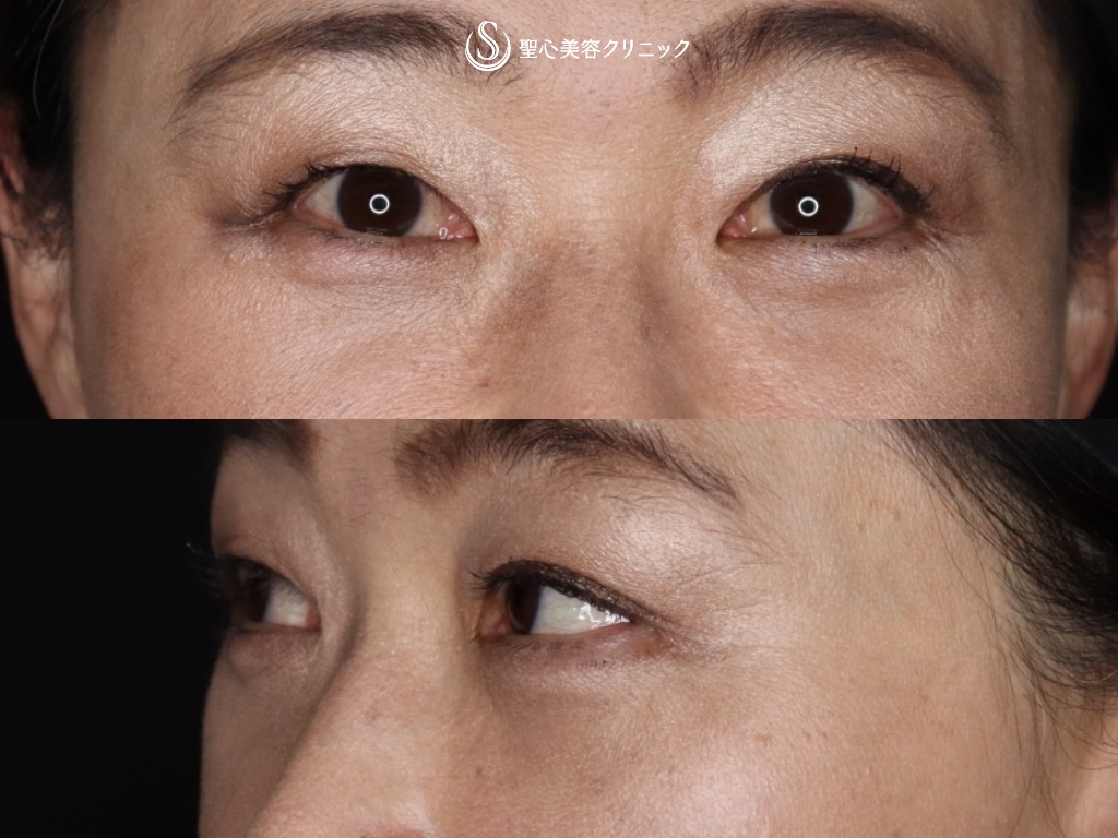 目の下の脂肪取り（経結膜下脱脂法）＋プレミアムPRP皮膚再生療法_After