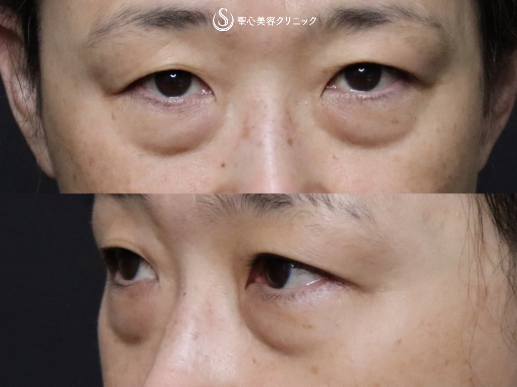 目の下の脂肪取り（経結膜下脱脂法）＋プレミアムPRP皮膚再生療法_Before